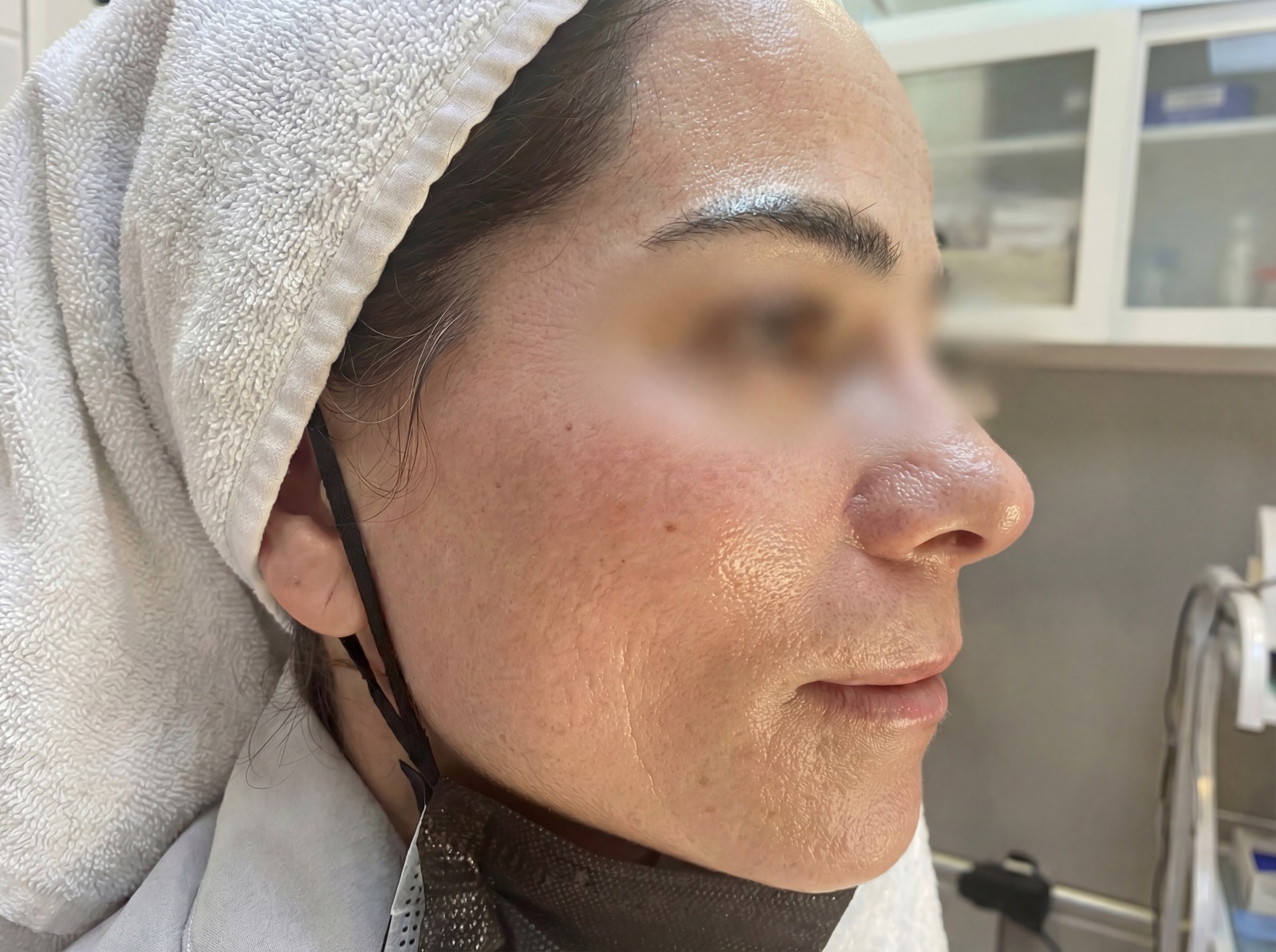 After Skin Brightening IV Drip