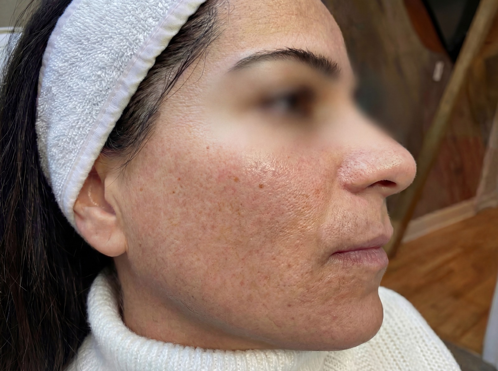 Before Skin Brightening IV Drip