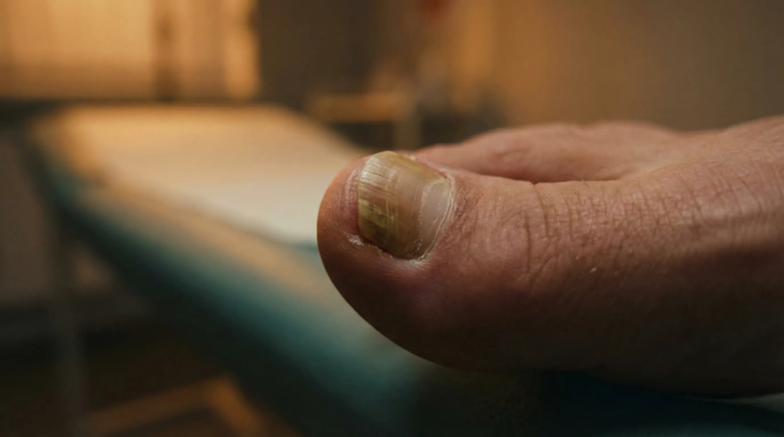 Laser Nail Fungus Treatment London