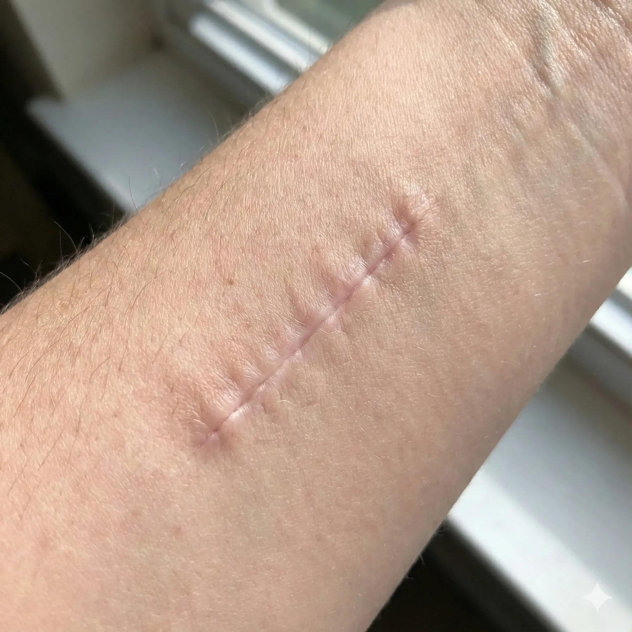 Surgical Scars