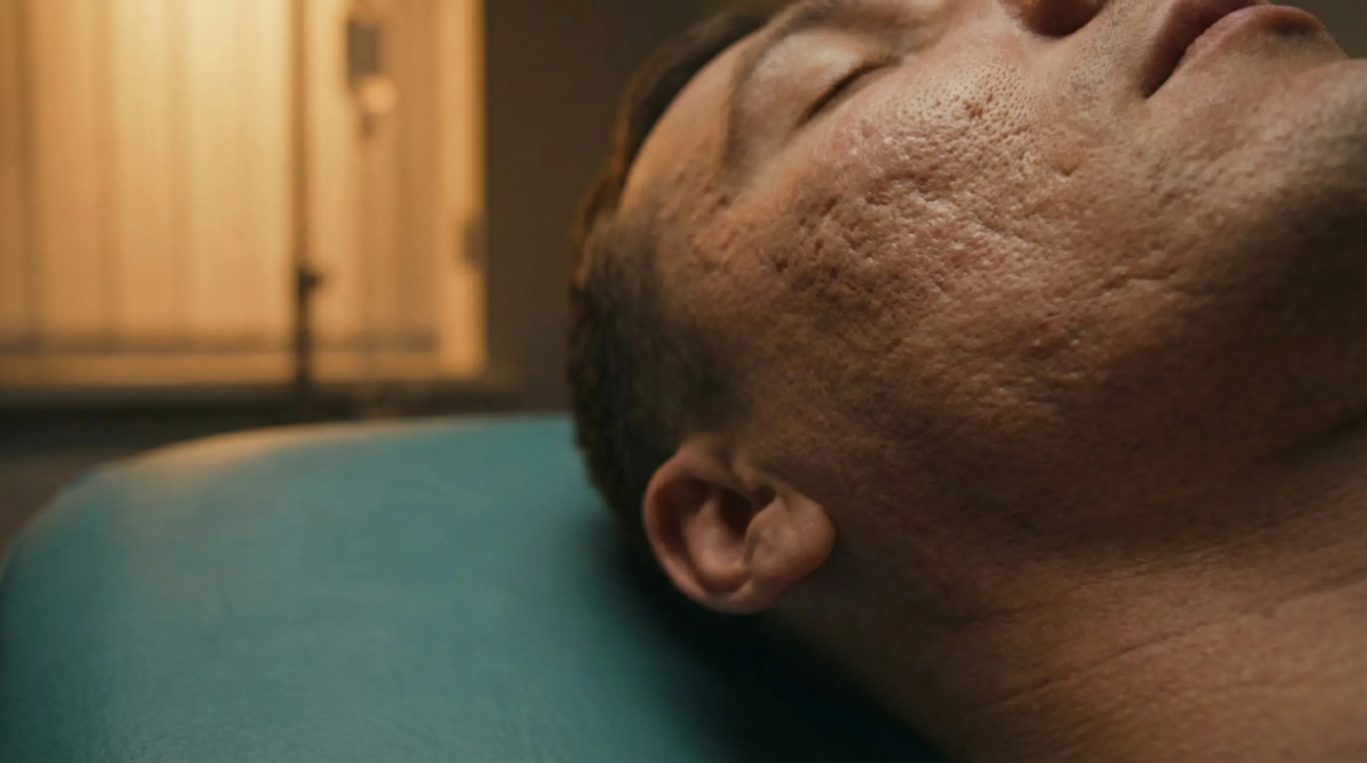 Acne Scar Treatment London