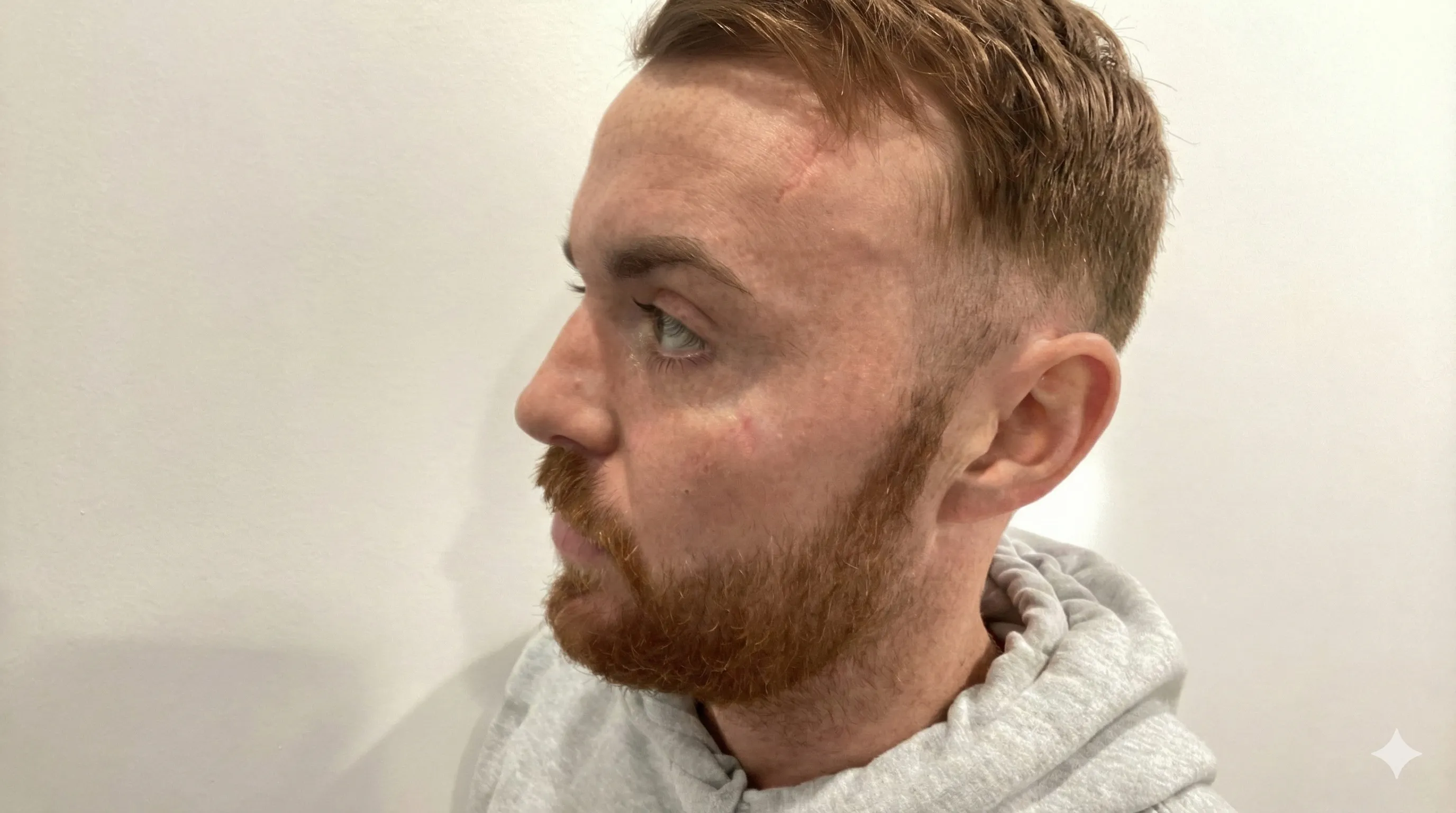 Before Case 01: Surgical Scar Revision (Head)