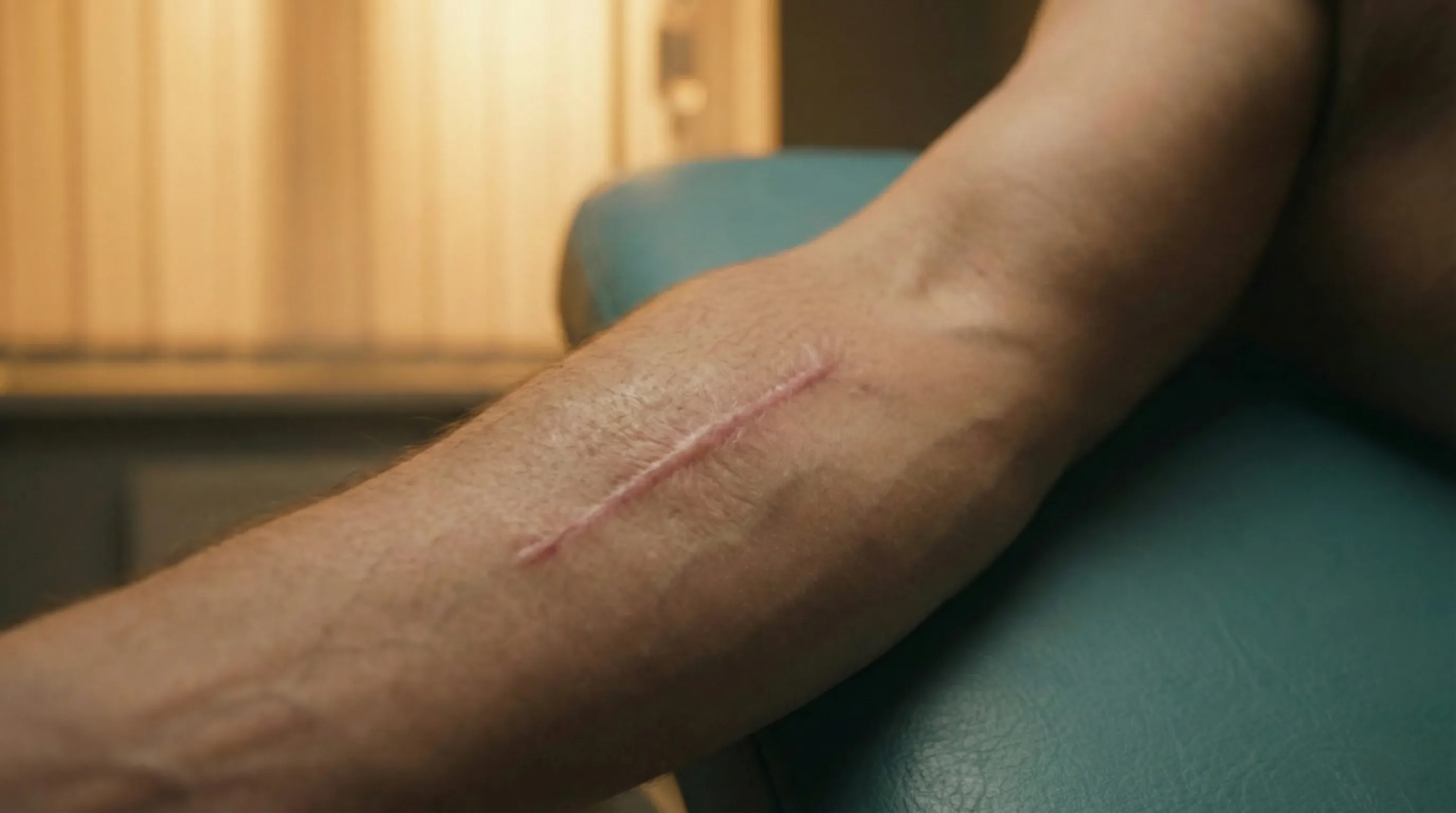 Surgical Scar Treatment London